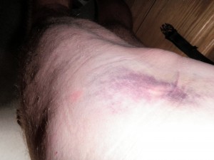 right hip after fall ing on cattle guard rail
